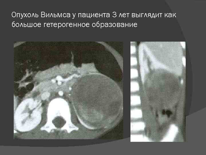 Опухоль Вильмса у пациента 3 лет выглядит как большое гетерогенное образование 