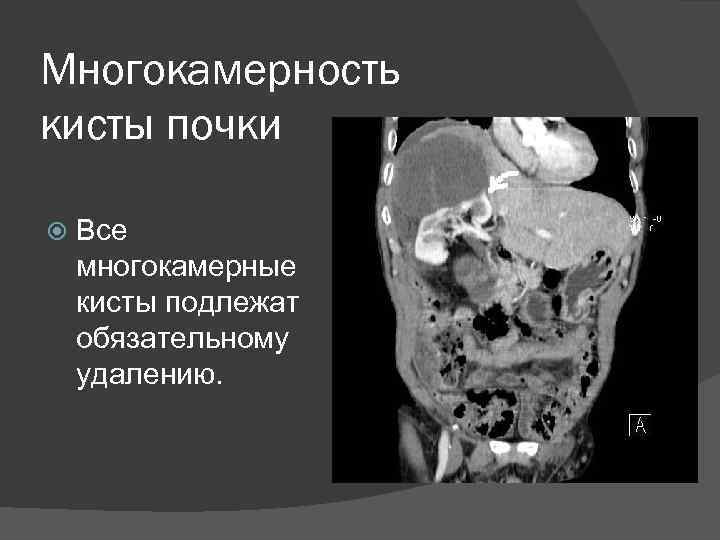 Многокамерность кисты почки Все многокамерные кисты подлежат обязательному удалению. 