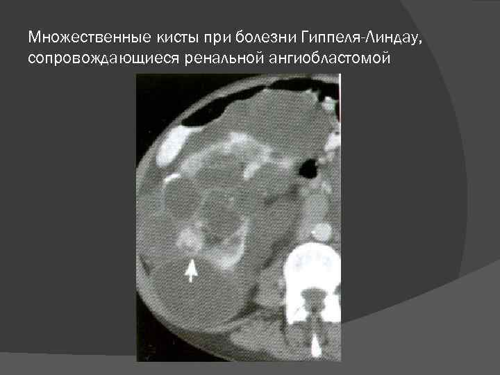 Множественные кисты при болезни Гиппеля-Линдау, сопровождающиеся ренальной ангиобластомой 