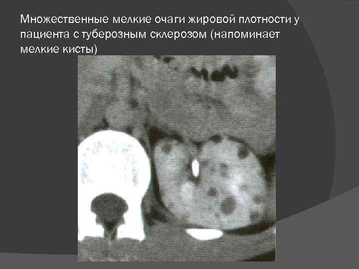 Множественные мелкие очаги жировой плотности у пациента с туберозным склерозом (напоминает мелкие кисты) 