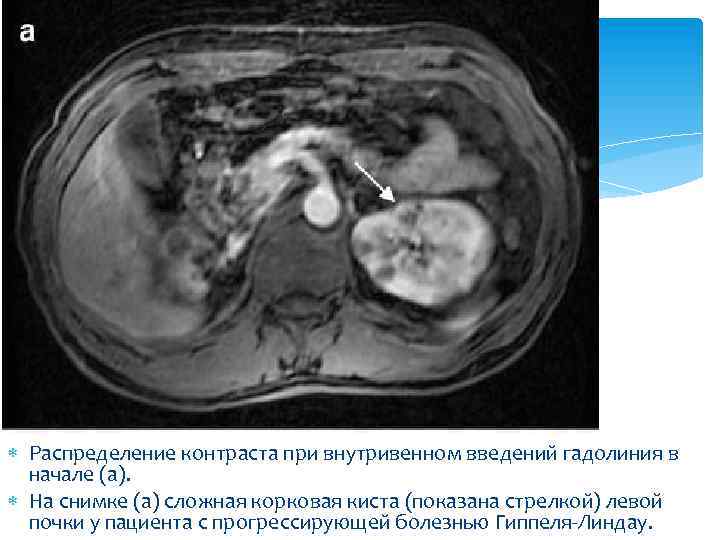  Распределение контраста при внутривенном введений гадолиния в начале (a). На снимке (a) сложная