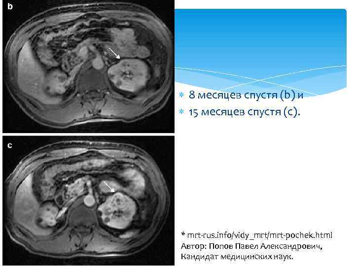  8 месяцев спустя (b) и 15 месяцев спустя (c). * mrt-rus. info/vidy_mrt/mrt-pochek. html