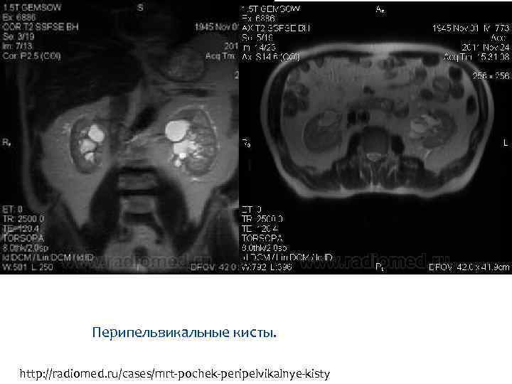 Перипельвикальные кисты. http: //radiomed. ru/cases/mrt-pochek-peripelvikalnye-kisty 