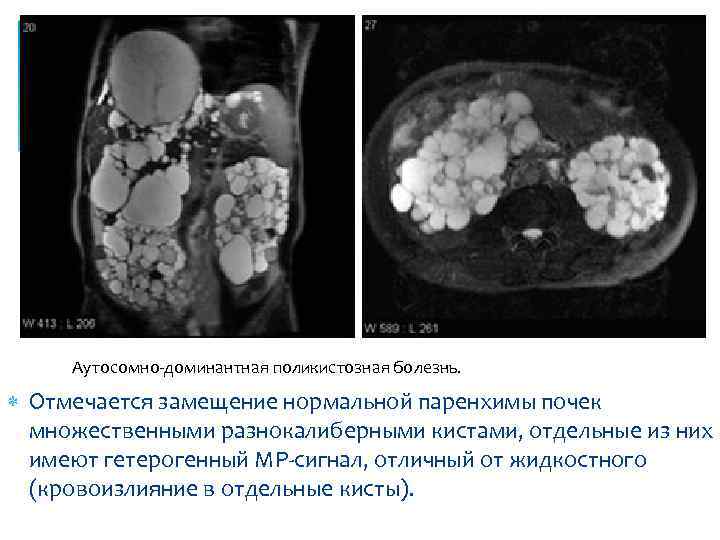 Что такое паренхима печени фото