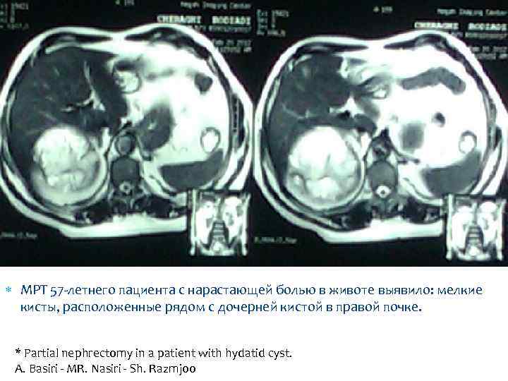 МРТ 57 -летнего пациента с нарастающей болью в животе выявило: мелкие кисты, расположенные