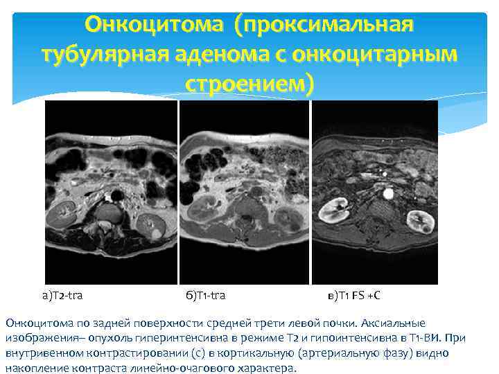 Онкоцитома (проксимальная тубулярная аденома с онкоцитарным строением) а)Т 2 -tra б)Т 1 -tra в)Т