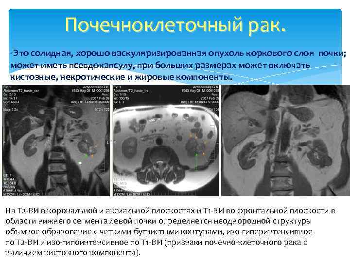 Почечноклеточный рак. -Это солидная, хорошо васкуляризированная опухоль коркового слоя почки; может иметь псевдокапсулу, при