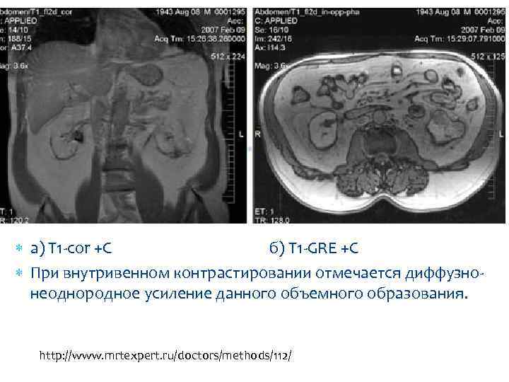  а) Т 1 -cor +C б) Т 1 -GRE +C При внутривенном контрастировании