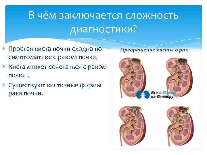 В чём заключается сложность диагностики? Простая киста почки сходна по симптоматике с раком почки,