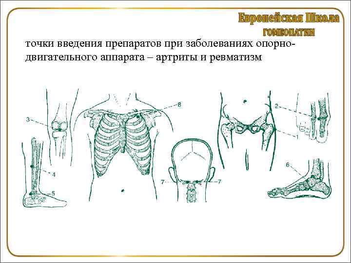 точки введения препаратов при заболеваниях опорнодвигательного аппарата – артриты и ревматизм 