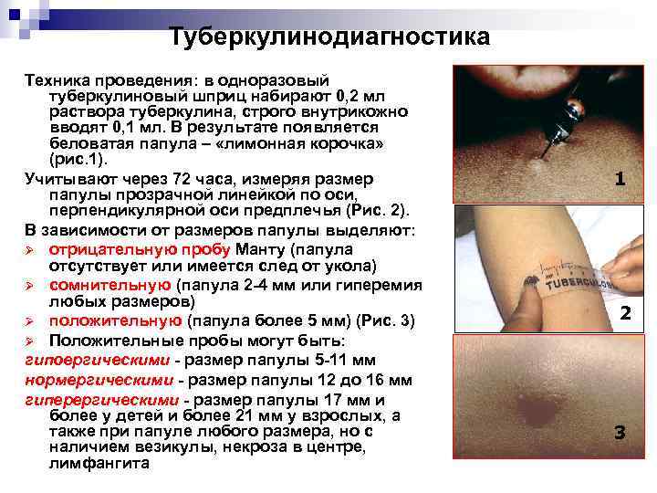 Туберкулинодиагностика Техника проведения: в одноразовый туберкулиновый шприц набирают 0, 2 мл раствора туберкулина, строго