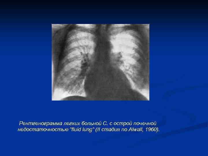 Рентгенограмма легких больной С. с острой почечной недостаточностью “fluid lung” (II стадия по Alwall,