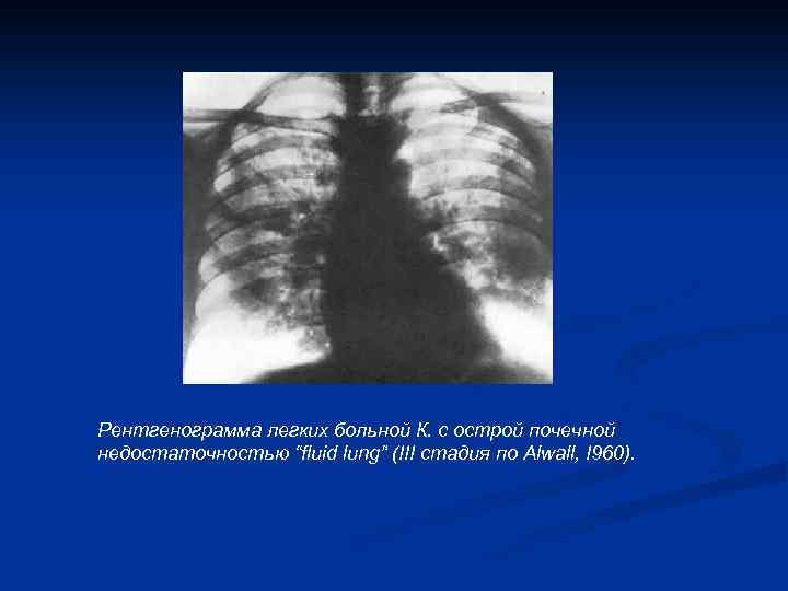 Рентгенограмма легких больной К. с острой почечной недостаточностью “fluid lung” (III стадия по Alwall,