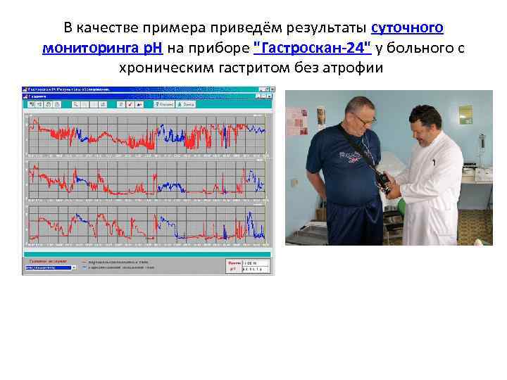 В качестве примера приведём результаты суточного мониторинга р. Н на приборе "Гастроскан-24" у больного