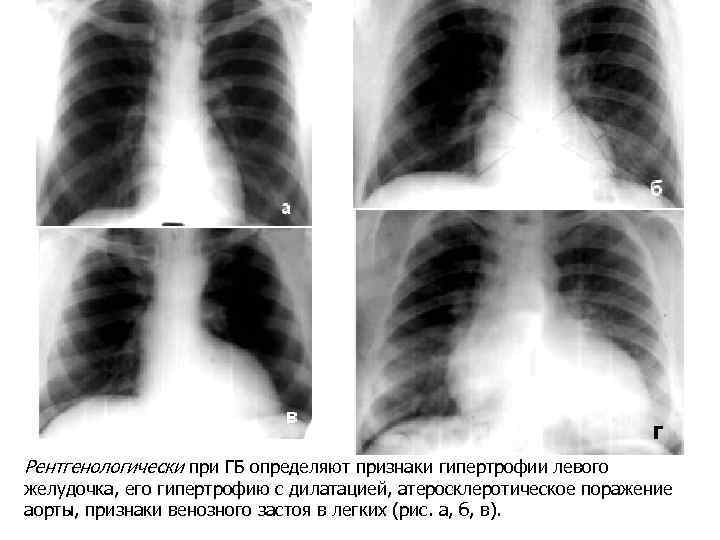Рентгенологически при ГБ определяют признаки гипертрофии левого желудочка, его гипертрофию с дилатацией, атеросклеротическое поражение