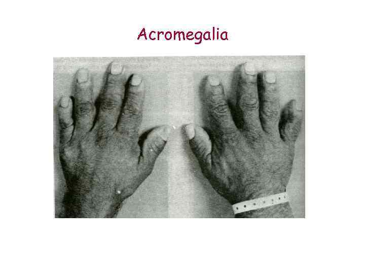 Acromegalia 