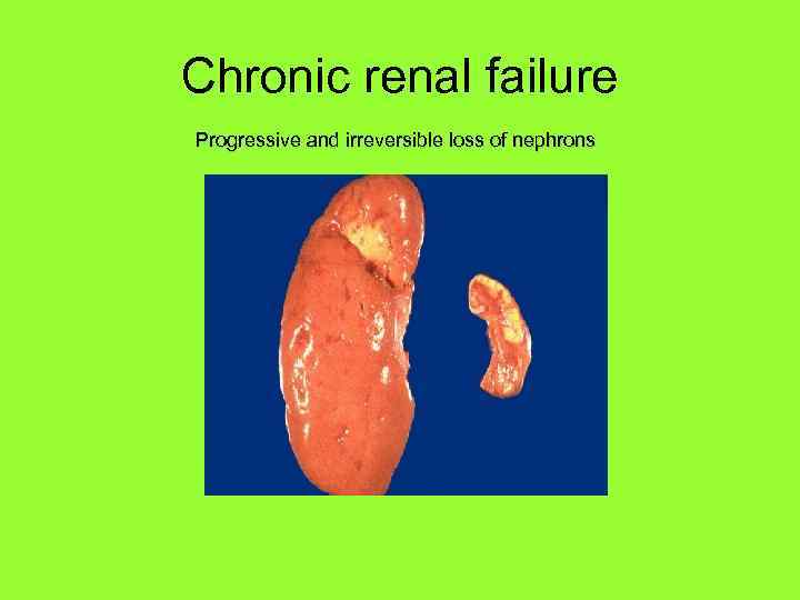 Chronic renal failure Progressive and irreversible loss of nephrons 