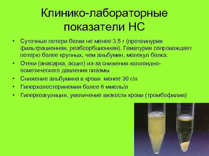 Клинико-лабораторные показатели НС • Суточные потери белки не менее 3, 5 г (протеинурия фильтрационная,