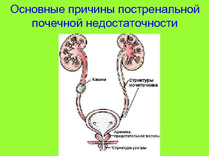 Основные причины постренальной почечной недостаточности 