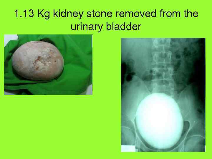 1. 13 Kg kidney stone removed from the urinary bladder 