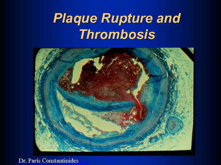 Plaque Rupture and Thrombosis Dr. Paris Constantinides 