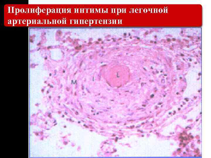 Пролиферация интимы при легочной артериальной гипертензии 