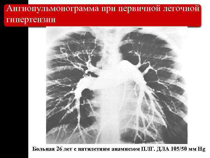 Ангиопульмонограмма при первичной легочной гипертензии Больная 26 лет с пятилетним анамнезом ПЛГ. ДЛА 105/50