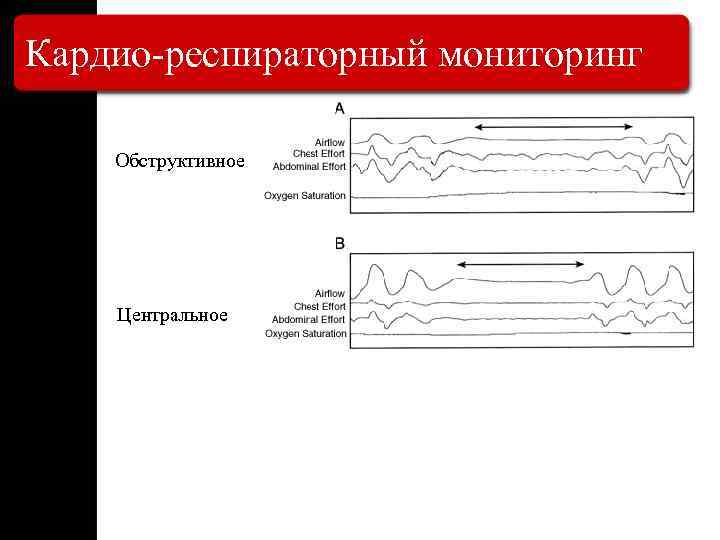 Кардио-респираторный мониторинг Обструктивное Центральное 