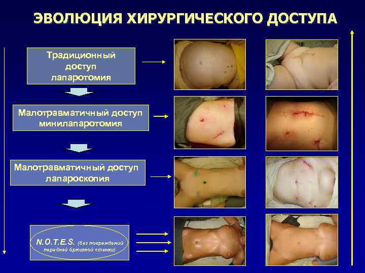 ЭВОЛЮЦИЯ ХИРУРГИЧЕСКОГО ДОСТУПА Традиционный доступ лапаротомия Малотравматичный доступ минилапаротомия Малотравматичный доступ лапароскопия N. O.