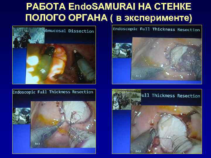 РАБОТА Endo. SAMURAI НА СТЕНКЕ ПОЛОГО ОРГАНА ( в эксперименте) 