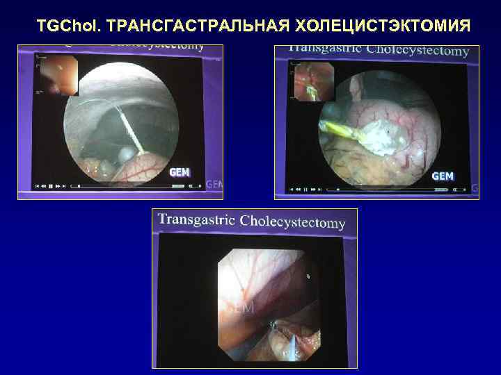 TGChol. ТРАНСГАСТРАЛЬНАЯ ХОЛЕЦИСТЭКТОМИЯ 