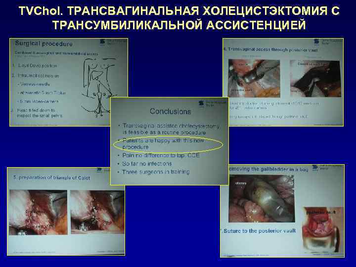 TVChol. ТРАНСВАГИНАЛЬНАЯ ХОЛЕЦИСТЭКТОМИЯ С ТРАНСУМБИЛИКАЛЬНОЙ АССИСТЕНЦИЕЙ 