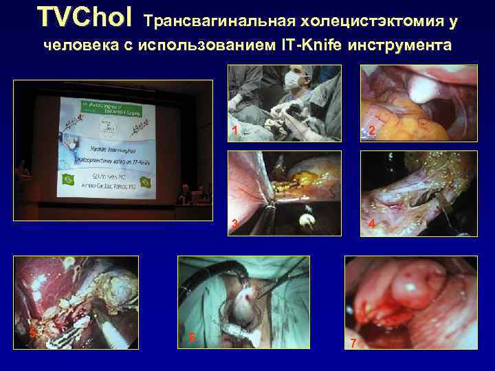 TVChol Трансвагинальная холецистэктомия у человека с использованием IT-Knife инструмента 1 3 5 6 2