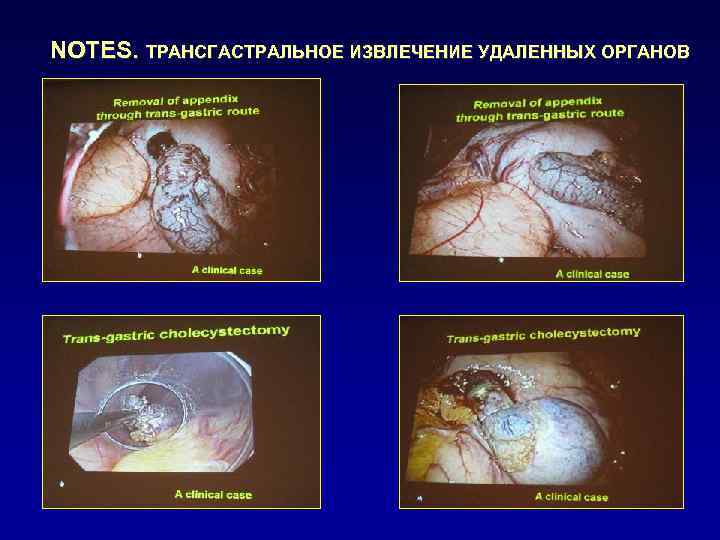 NOTES. ТРАНСГАСТРАЛЬНОЕ ИЗВЛЕЧЕНИЕ УДАЛЕННЫХ ОРГАНОВ 