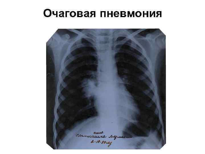 Очаговая пневмония 