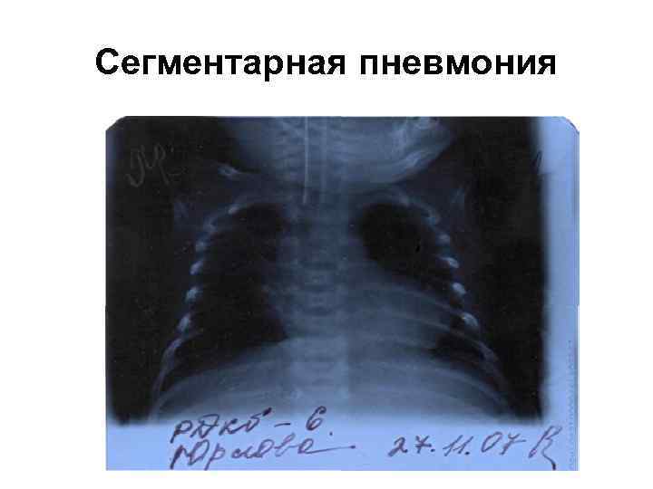Сегментарная пневмония 