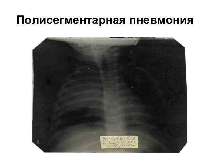 Полисегментарная пневмония 