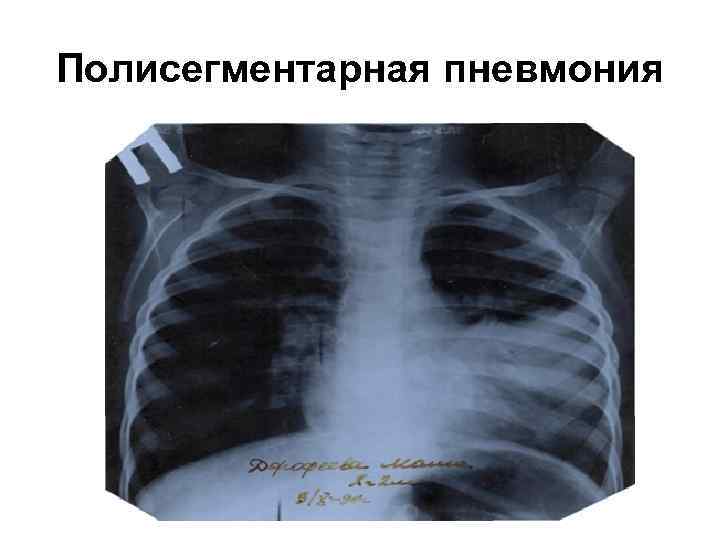 Полисегментарная пневмония 