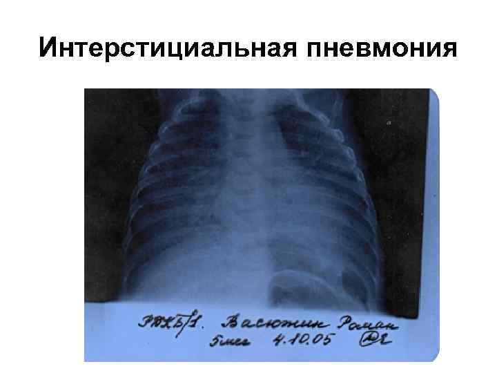 Интерстициальная пневмония 