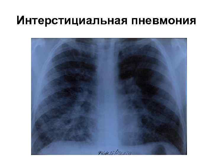 Интерстициальная пневмония 
