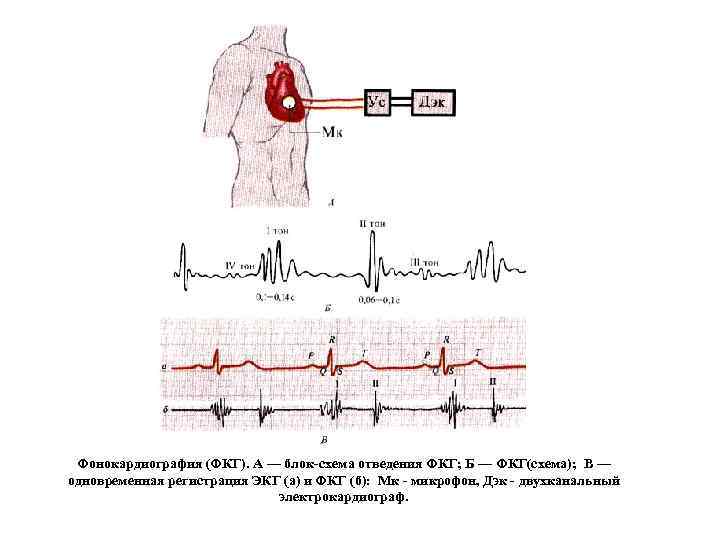 Фонокардиография (ФКГ). А — блок-схема отведения ФКГ; Б — ФКГ(схема); В — одновременная регистрация