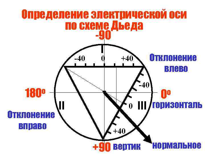 Определение электрической оси по схеме Дьеда -90 I -40 180 о Отклонение вправо 0