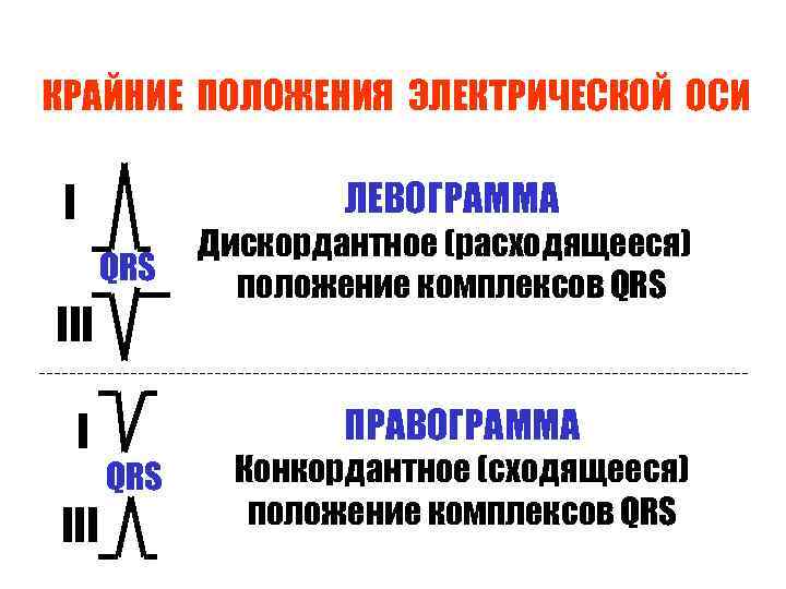 КРАЙНИЕ ПОЛОЖЕНИЯ ЭЛЕКТРИЧЕСКОЙ ОСИ ЛЕВОГРАММА I QRS III I III Дискордантное (расходящееся) положение комплексов