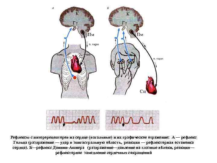 Рефлексы с интерорецепторов на сердце (вагальные) и их графическое отражение: А — рефлекс Гольца