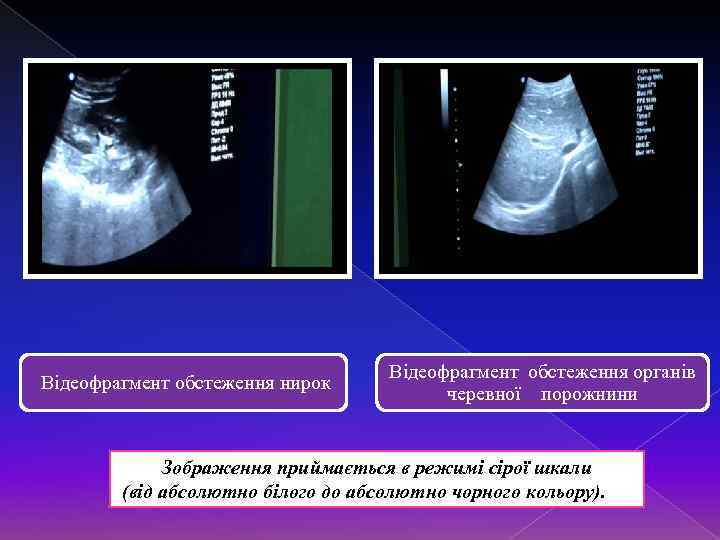 Відеофрагмент обстеження нирок Відеофрагмент обстеження органів черевної порожнини Зображення приймається в режимі сірої шкали