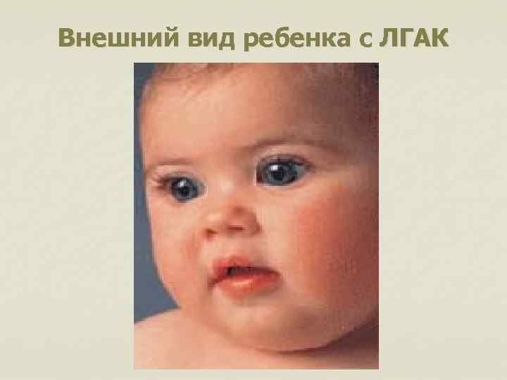 Внешний вид ребенка с ЛГАК 