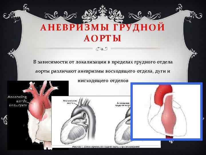 АНЕВРИЗМЫ ГРУДНОЙ АОРТЫ В зависимости от локализации в пределах грудного отдела аорты различают аневризмы