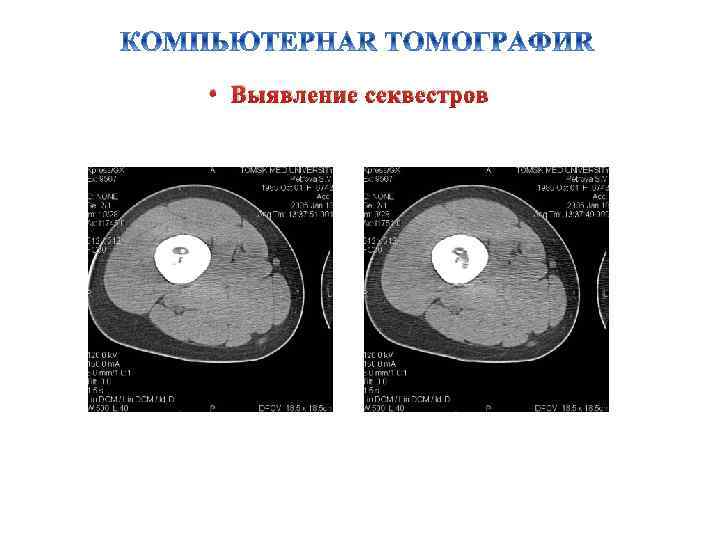  • Выявление секвестров 