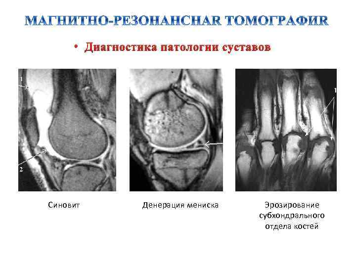  • Диагностика патологии суставов Синовит Денерация мениска Эрозирование субхондрального отдела костей 