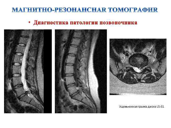  • Диагностика патологии позвоночника Ущемленная грыжа диска L 5 -S 1 